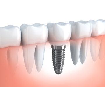 Single Teeth Implant