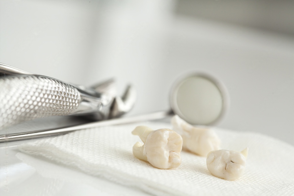 A Patient's Guide to Tooth Extraction and Aftercare